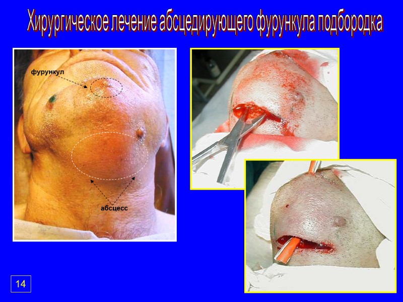 Хирургическое лечение абсцедирующего фурункула подбородка фурункул абсцесс 14